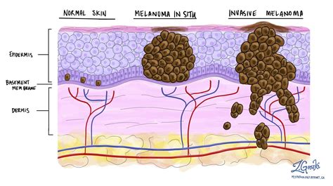 what are skin structures of melanoma